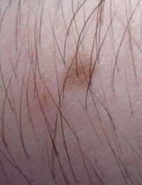 Laser Hair Removal Patch Test Laser