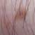 About Laser Hair Removal Patch Tests