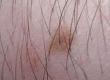 About Laser Hair Removal Patch Tests