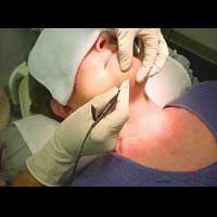 Electrolysis Hair Removal By