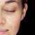 Problems with Laser Treatment